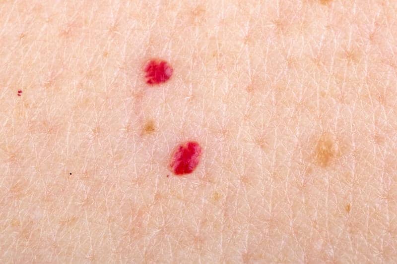 What Are Red Moles on the Skin?