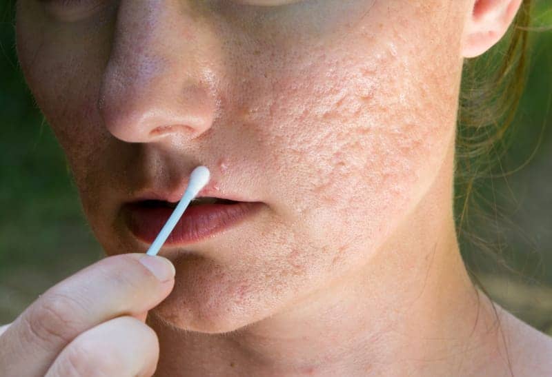 How to Fix Those Annoying Scars and Bumps Caused By Acne