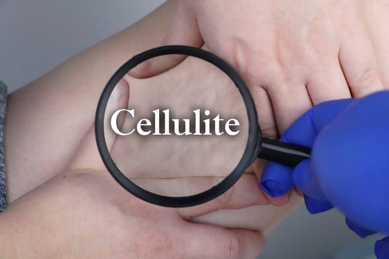 The Top 5 In-Office Treatments That Help Make Stubborn Cellulite Disappear