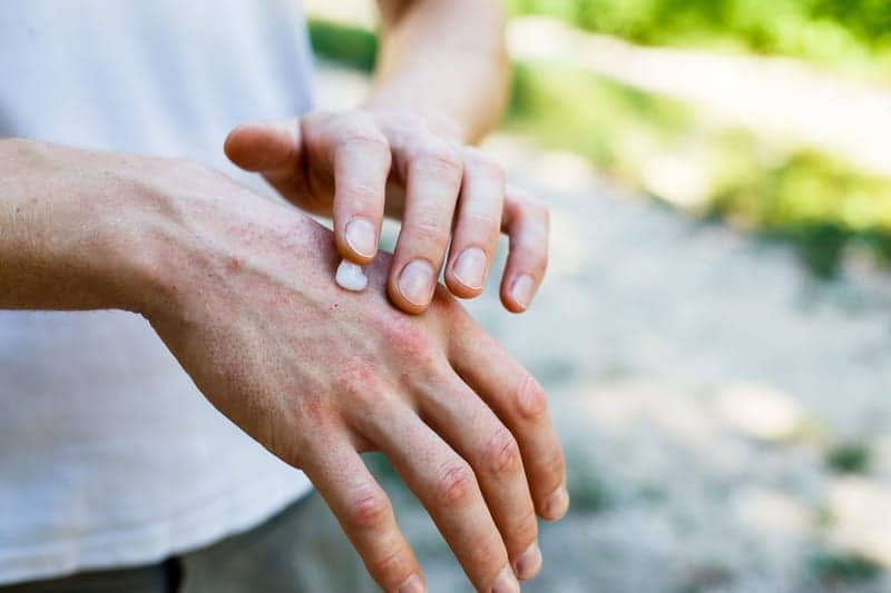 Topical Foam May Extend Remission From Plaque Psoriasis
