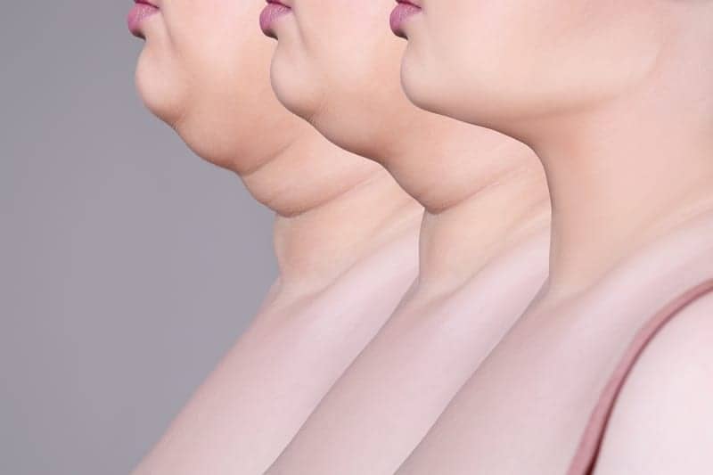 It’s Official: The Necklift Is Having a Moment