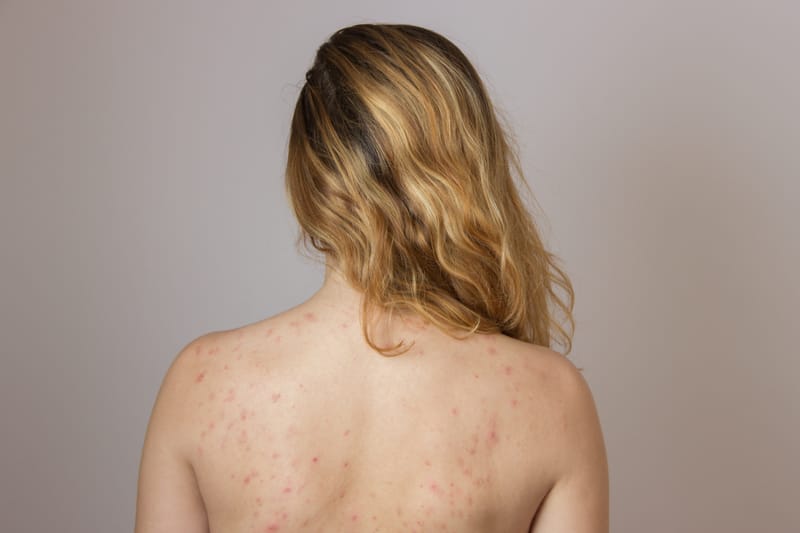 Why More People Are Getting Body Acne Than Ever