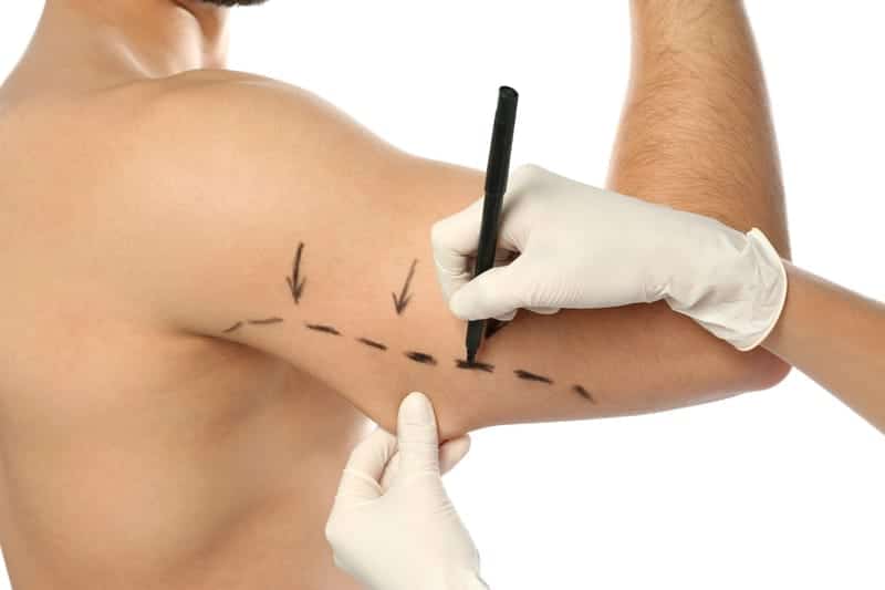 Arm Lift Surgery: Everything You Need to Know