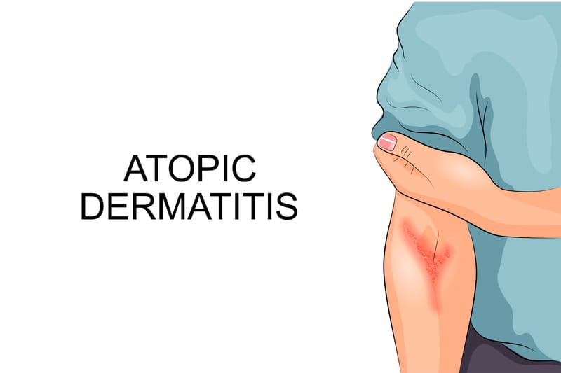 Atopic Dermatitis More Common in Adults with Multiple Autoimmune Diseases