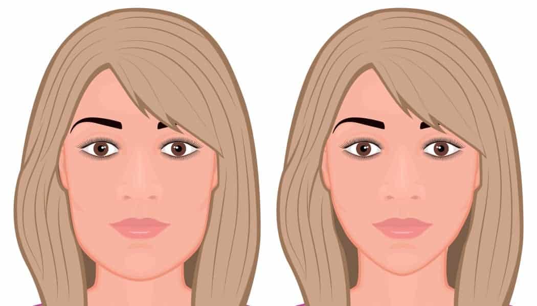 Genioplasty: Overview