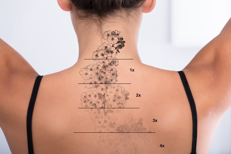 Fundamental Principles for Laser Tattoo Removal