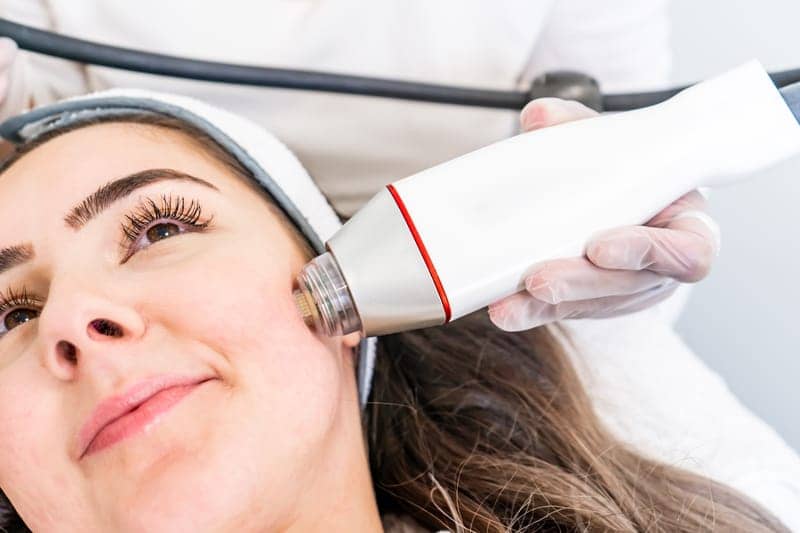 All About Radiofrequency Microneedling