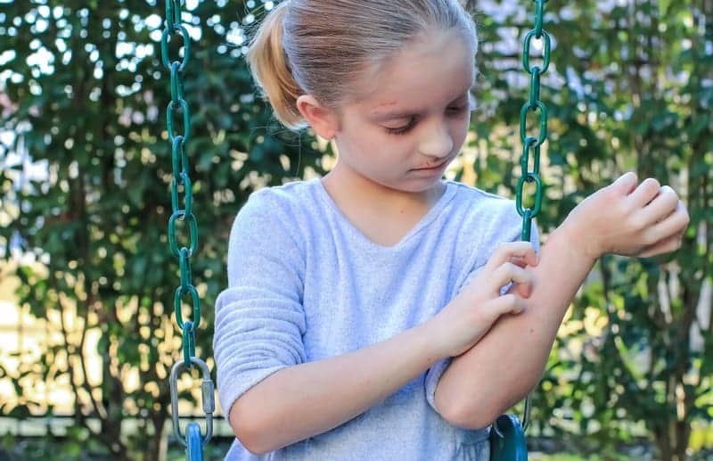 Characterizing Pollen Season Flares in Children With Atopic Eczema