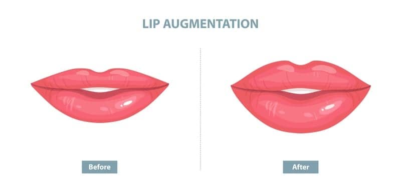 What Exactly Is a Lip Lift? Plastic Surgeons Explain
