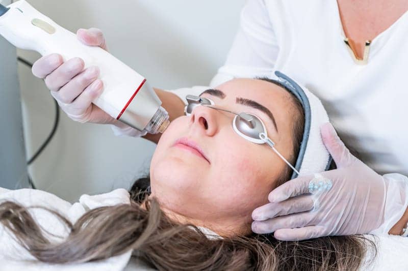Everything You Need to Know About Radiofrequency Microneedling for Acne Scars