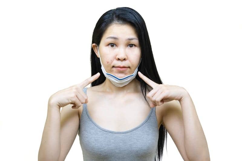 Your ‘Maskne’ Might Not Be Acne at All